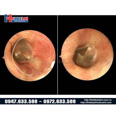 Máy nội soi tai mũi họng cầm tay full HD Máy nội soi tai mũi họng cầm tay full HD